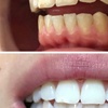 Image 4: Signature Teeth Whitening or Signature Teeth Whitening Package of 3