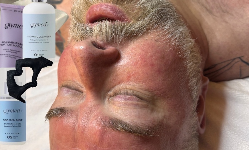 Image 3: Enhance Your Glow with 1, 2, or 3 Chemical Peels