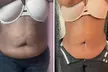 Up to 50% Off on Lipo - Non-Invasive Laser-iLipo at Extreme body sculpting - Second Medium