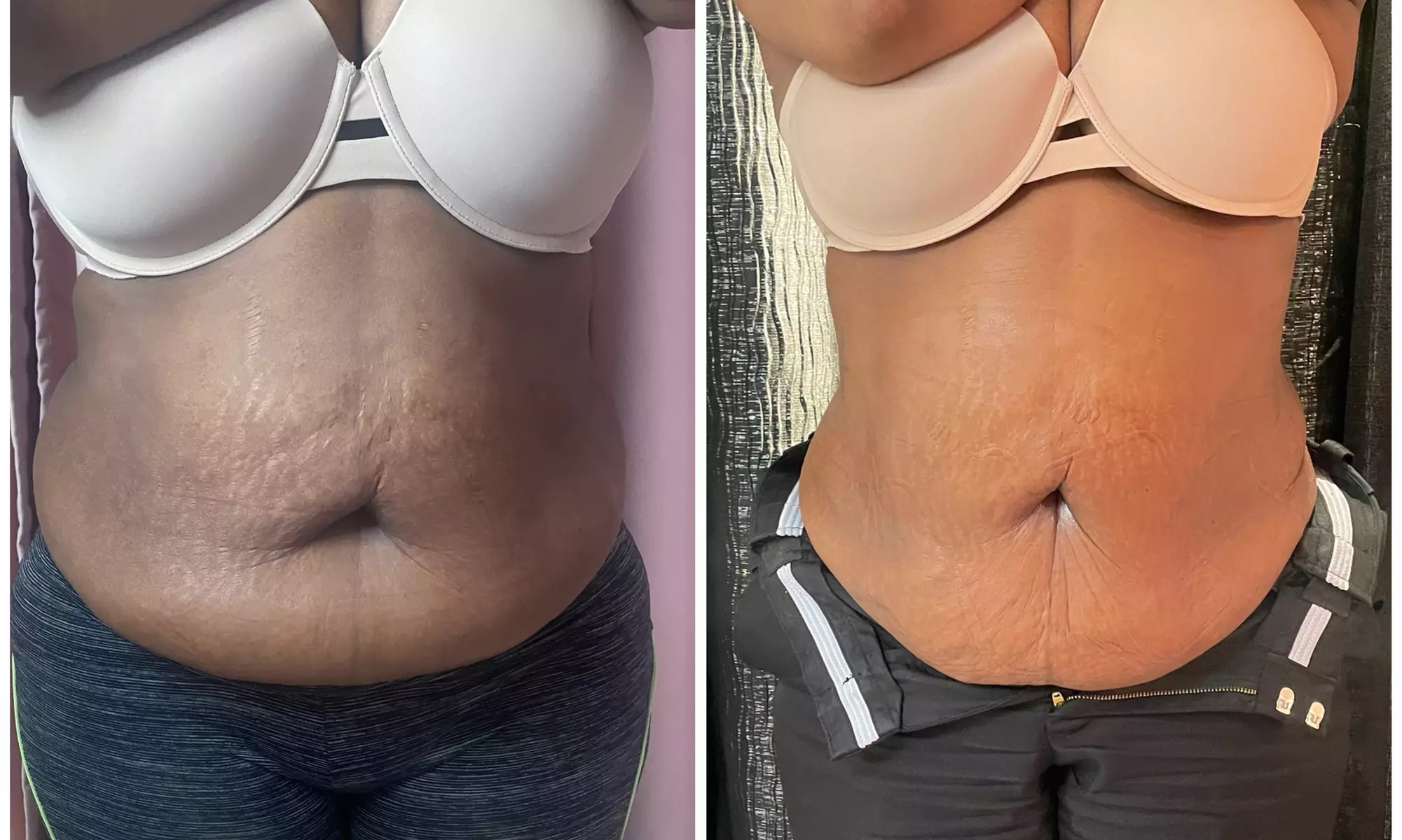 Up to 66% Off on Lipo - Non-Invasive Laser-iLipo at Extreme body sculpting