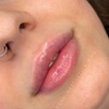 Image 1: Up to 60% Off on Injection - Dermal Filler at La Bella Beauty Bar