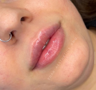 0.5 ml Lip Filler Treatment with Consultation - La Bella Beauty Bar