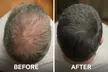 SMP Consultation w/ Hairline Focus, Density Boost, Moderate Hair Loss or Coverage with Care (Up to 59% Off) - Image 2