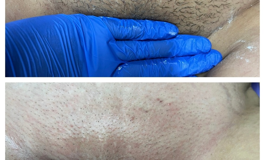 Image 1: Feel Smooth With a Refreshing Brazilian Wax, Perfect For Summer