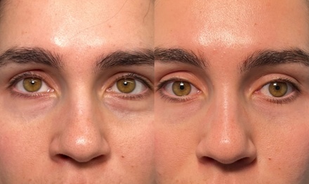 One Anti-Aging Treatment of PRF for Full-Face - ELin Medical Spa