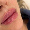 Image 1: Smooth & Contour: One or Full CC Syringe of Revanesse Versa Filler