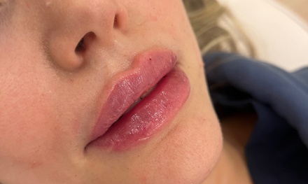 One Half CC Syringe of Revanesse Versa Filler - The Skin Room
