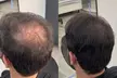 Scalp Micropigmentation: Men’s Hairline (One Session) for (Up to 46% Off) at Crown Point SMP - Second Medium