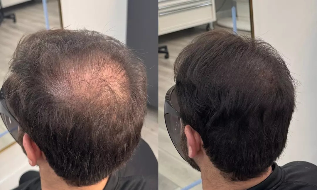 Scalp Micropigmentation: Men’s Hairline (One Session)