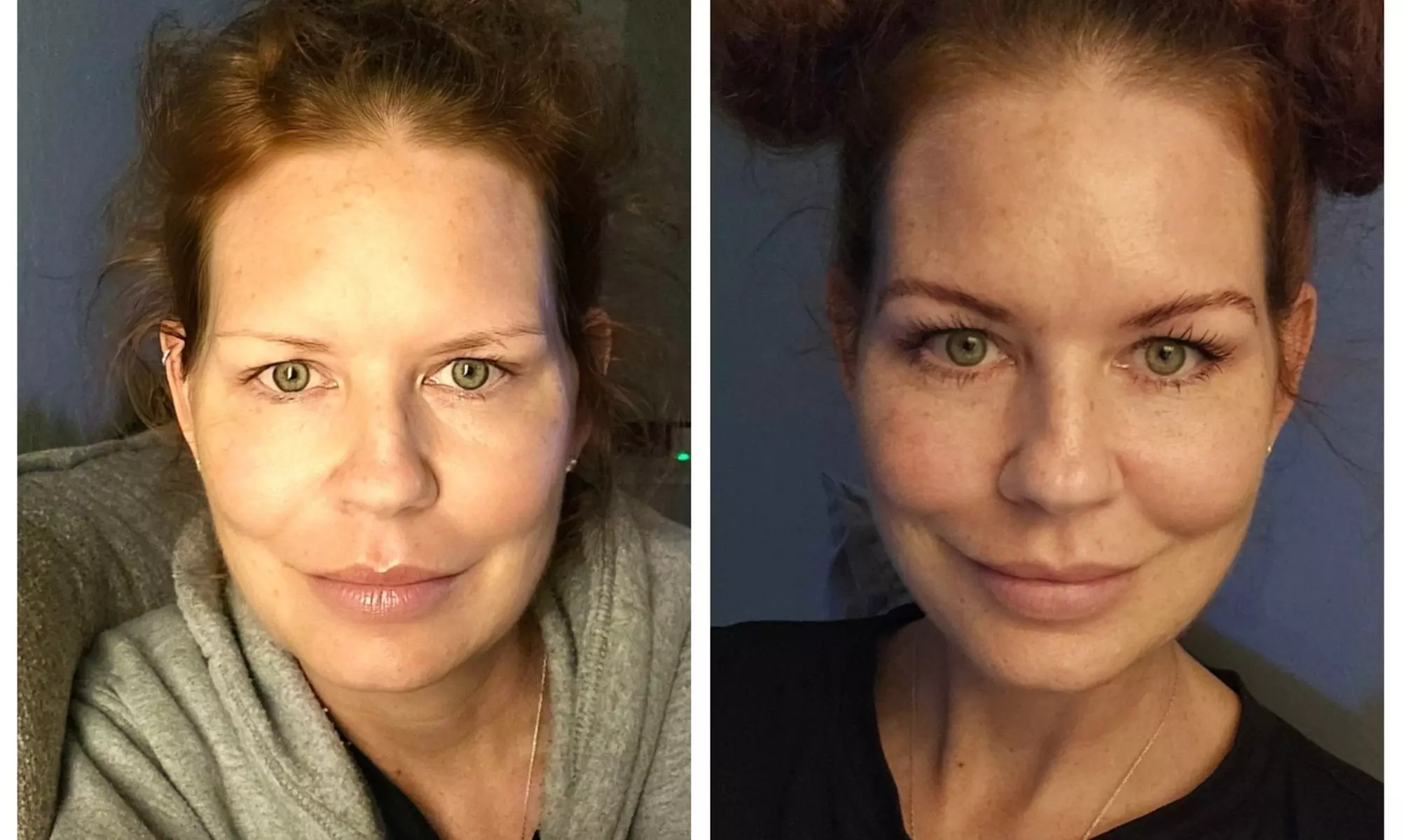 Revitalize your Look with One or Two Vials of Kybella at New You Medspa (Up to 39% Off) - Primary Image