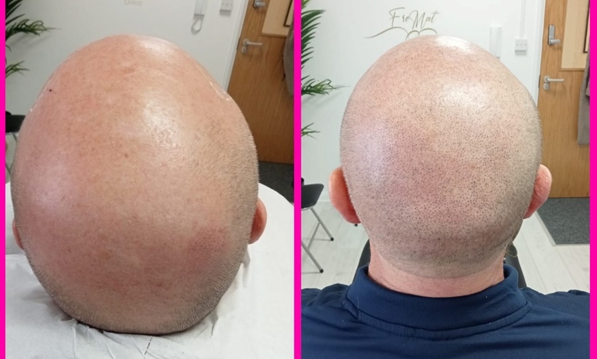 Image 3: Up to 50% Off on Salon - Scalp Care at FreMat SMP Clinic (Scalp Micropigmentation Clinic