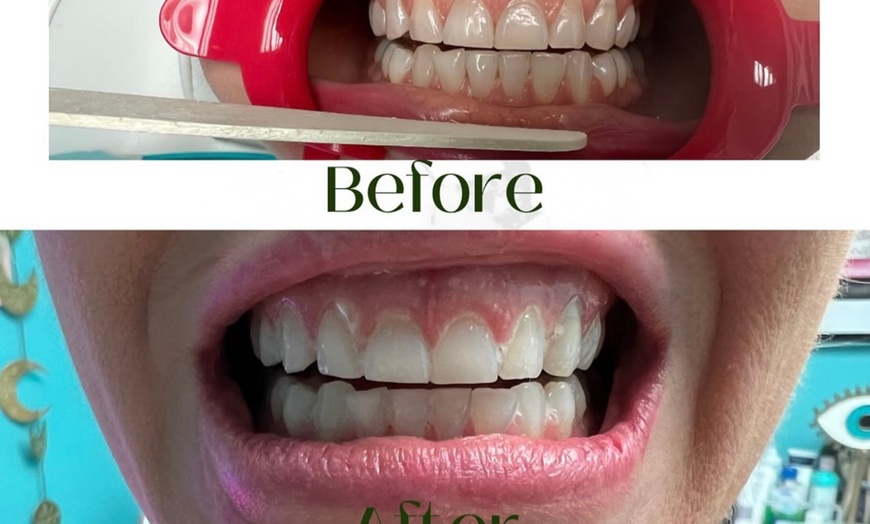 Image 1: Up to 76% Off on Teeth Whitening at Aesthetics Care Med Spa