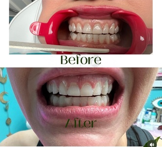 One Teeth Whitening Treatment - Aesthetics Care Med Spa