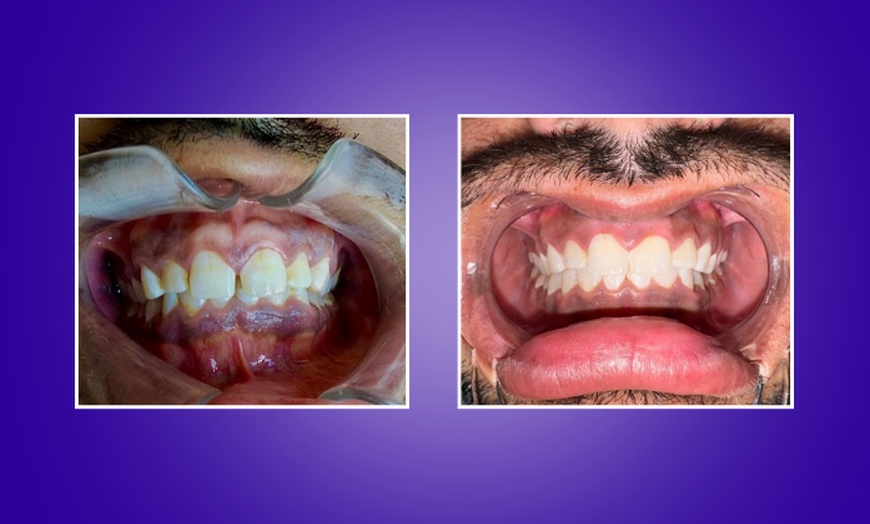 Image 5: Up to 67% Off on Invisible Aligners - StarSmiles Aligners