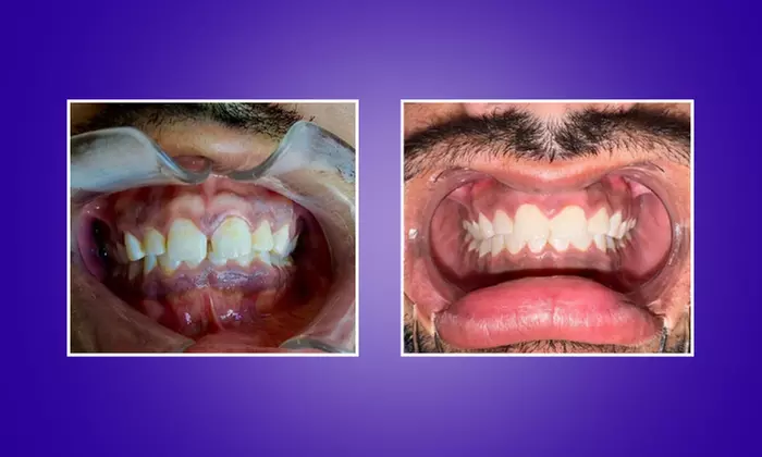 Up to 67% Off on Invisible Aligners - StarSmiles Aligners