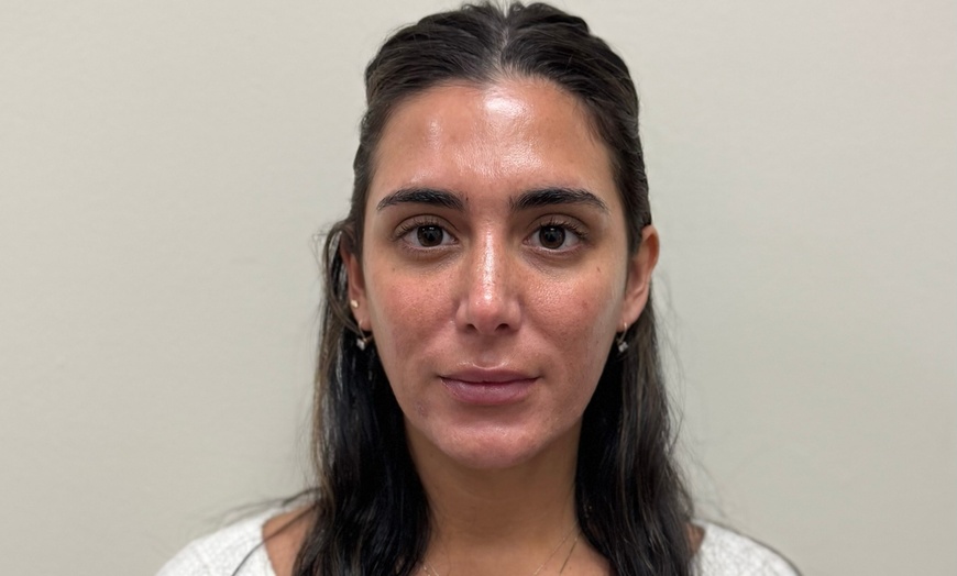 Image 3: Botox 20 - 40 units Lip Filler One Syringe
