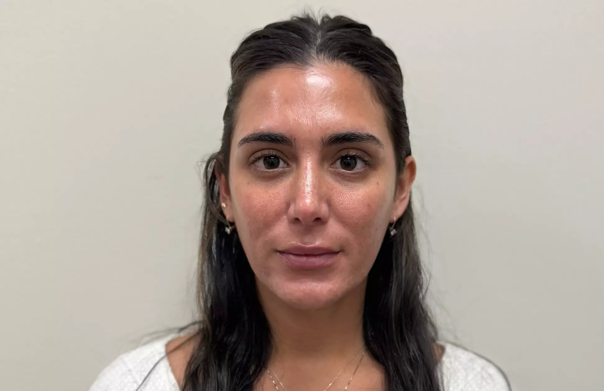 Botox Units (20–40) & Combo/Optional Lip Filler Syringe Injectables