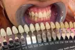 1 or 3 Teeth Whitening Sessions (30 or 45 Min) for a Dazzling Smile at Janiyah Gilliam Up To  48% Off - Second Medium