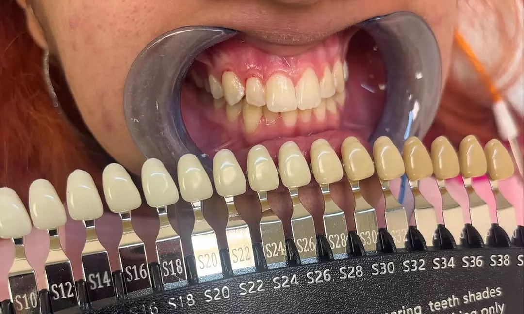 Teeth Whitening Sessions for a Radiantly Brighter Smile 
