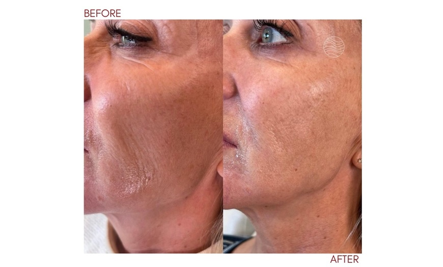 Image 14: Up to 50% Off on Injection - Dermal Filler at Dinah Manalo, NP - Aesthetic Medicine