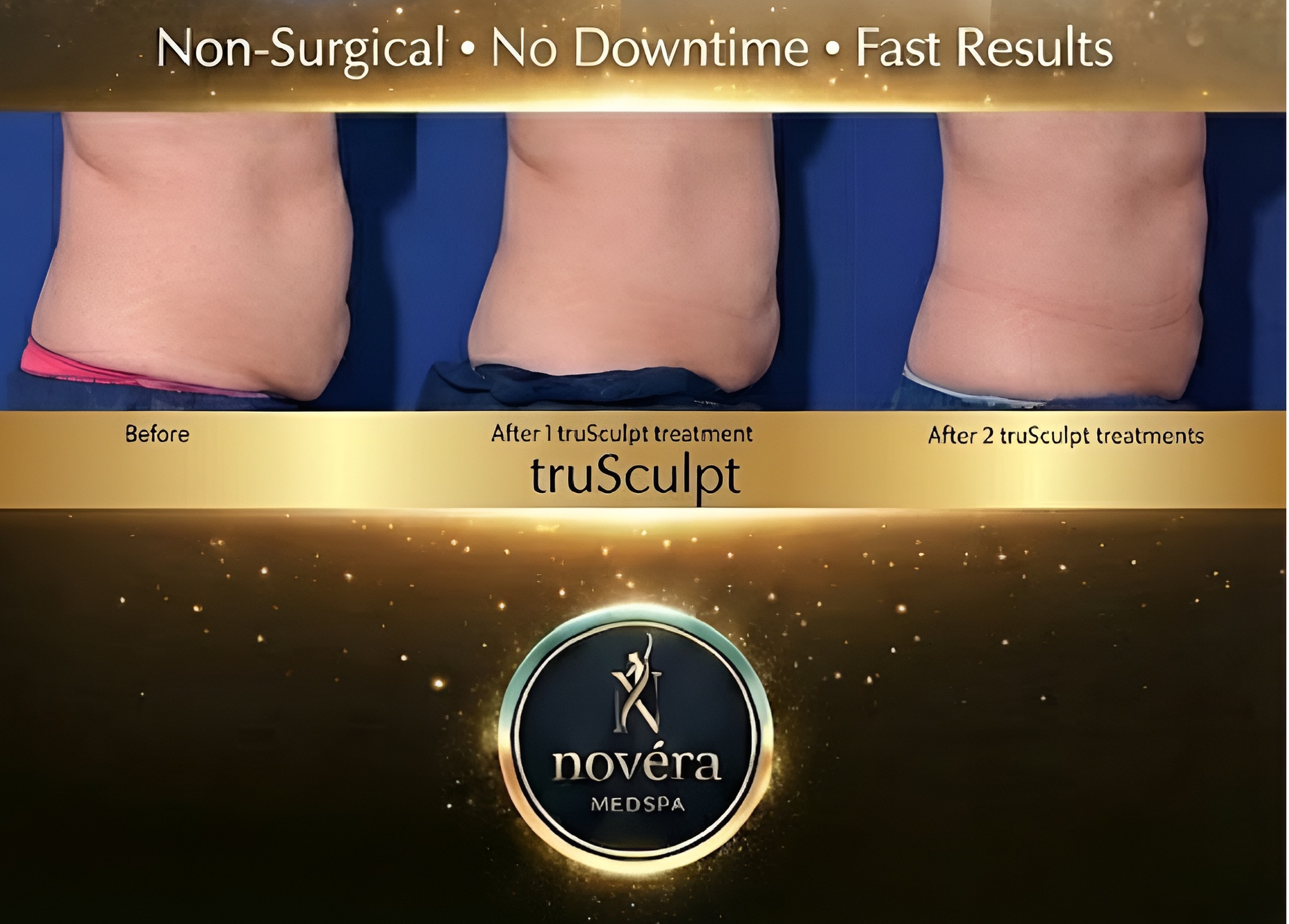 TruSculpt iD Fat Reduction Treatments