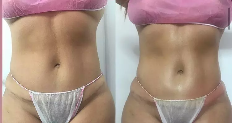 Experience CAMP Sacramento Aesthetics' Non-Invasive Laser Lipo Sessions with options of 2, 4, or 6 sessions up to 50% - Primary Image