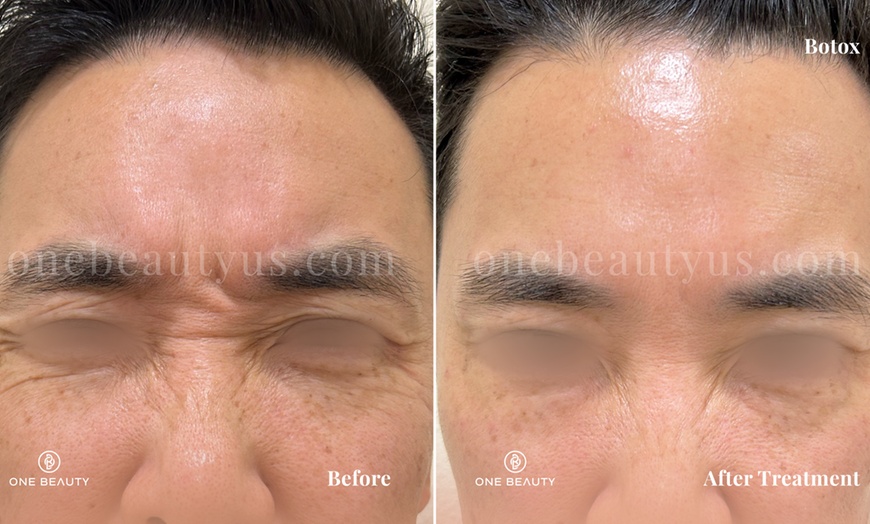 Image 3: Up to 51% Off on Injection - Botox at One Beauty Aesthetics
