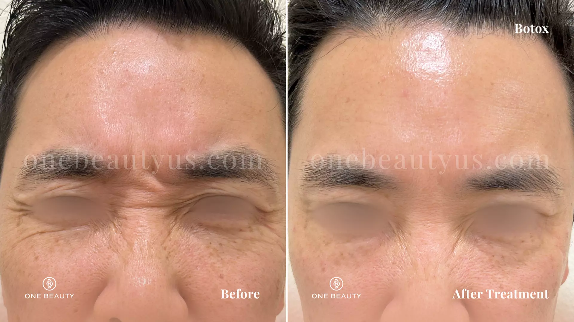 Up to 54% Off on Injection - Botox at One Beauty Aesthetics
