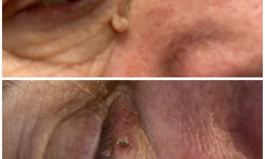 Image 2: Up to Unlimited Skin Tags, Milia, Blood Spot or Mole Wart Removal