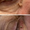 Image 2: Up to Unlimited Skin Tags, Milia, Blood Spot or Mole Wart Removal