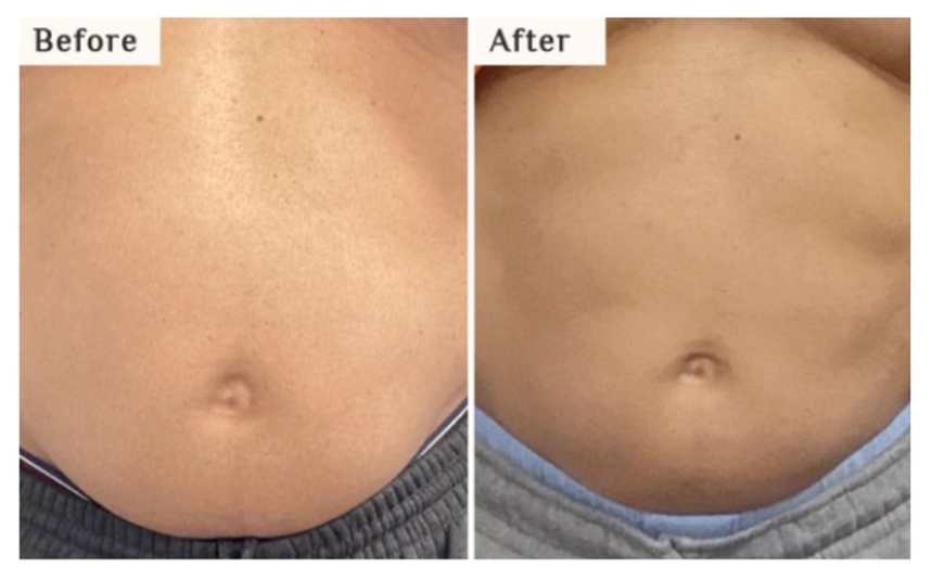 Image 4: Get One Session on Small Area: Mesotherapy Fat Melting (PCDC)