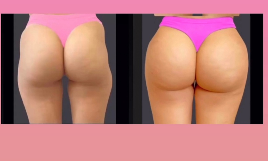 Image 1: Discover JP Beverly Hills Skin Clinic's Non-Surgical Brazilian Butt Lift with Options and Up to 12% Off