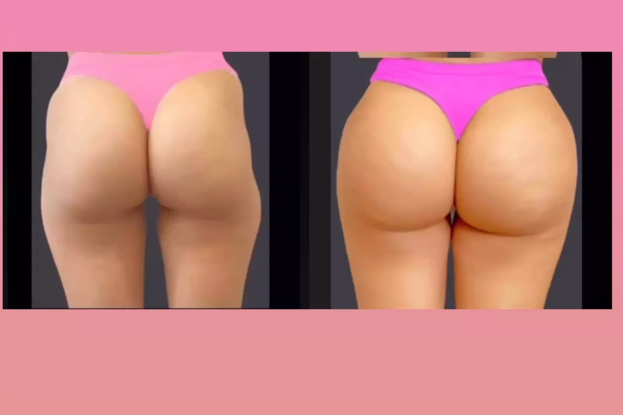 Discover JP Beverly Hills Skin Clinic's Non-Surgical Brazilian Butt Lift with Options and Up to 12% Off - Primary Image