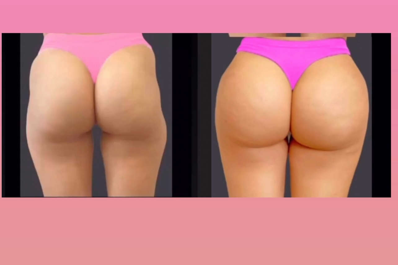 Discover JP Beverly Hills Skin Clinic's Non-Surgical Brazilian Butt Lift with Options and Up to 12% Off