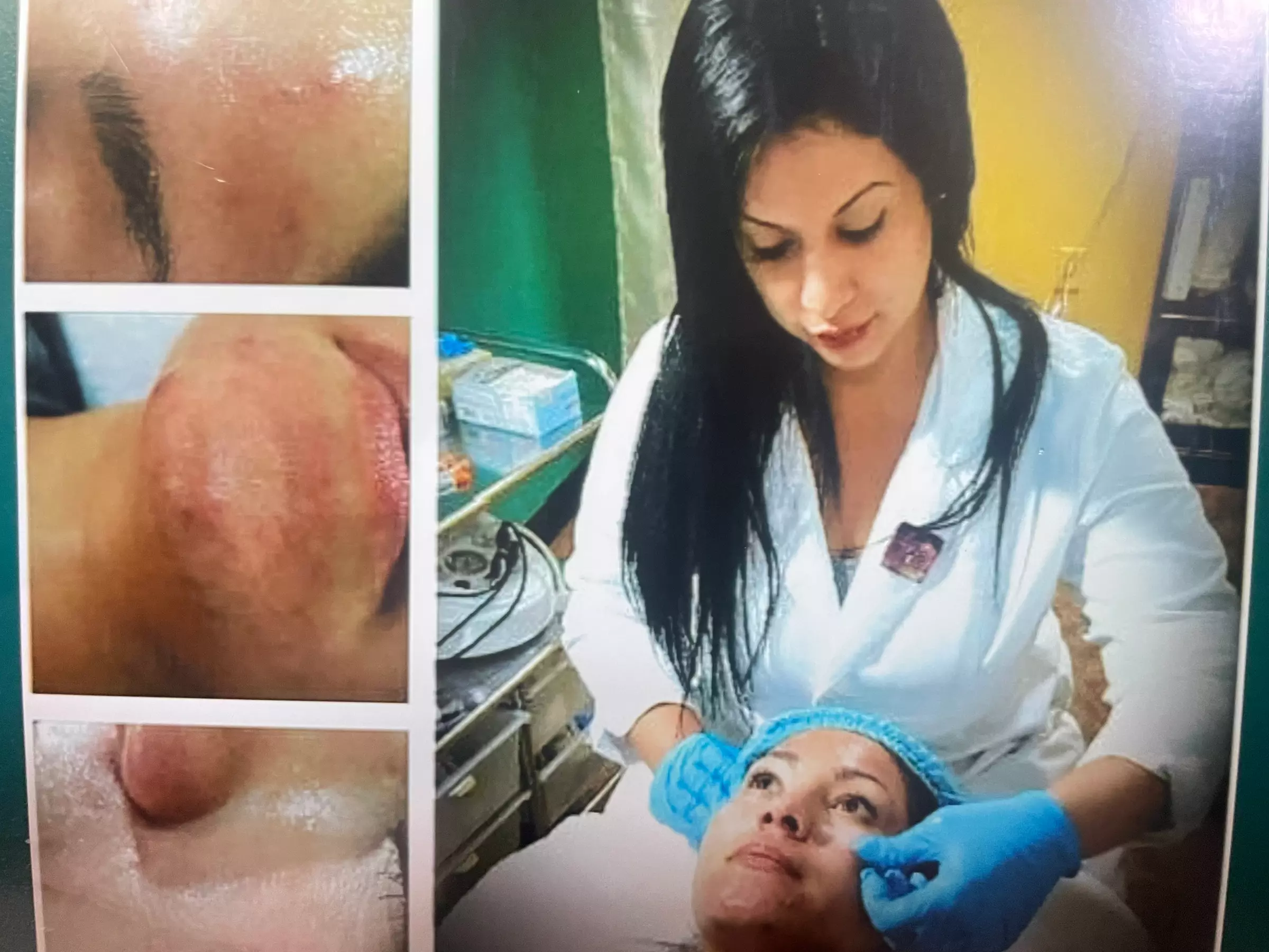 1, 2, or 3 Sessions RF Skin Tightening, Microdermabrasion &  Peel 
