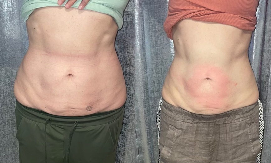 Image 1: Noninvasive ultrasonic cavitation sessions to target stubborn fat