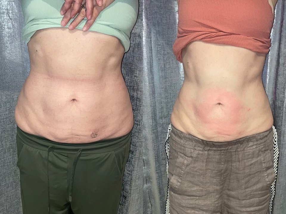 Noninvasive ultrasonic cavitation sessions to target stubborn fat
