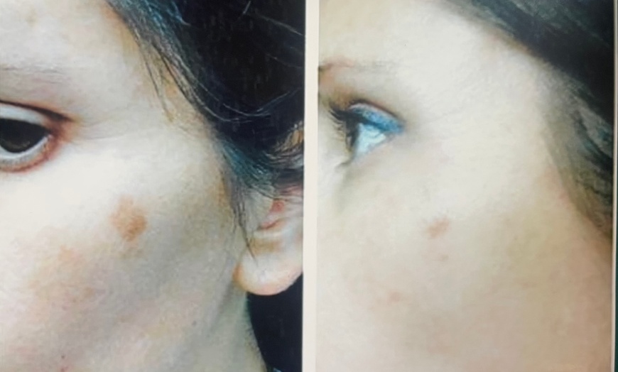 Image 3: 1, 2, or 3 Sessions RF Skin Tightening, Microdermabrasion &  Peel 