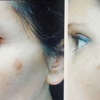 Image 2: 1, 2, or 3 Sessions RF Skin Tightening, Microdermabrasion &  Peel 