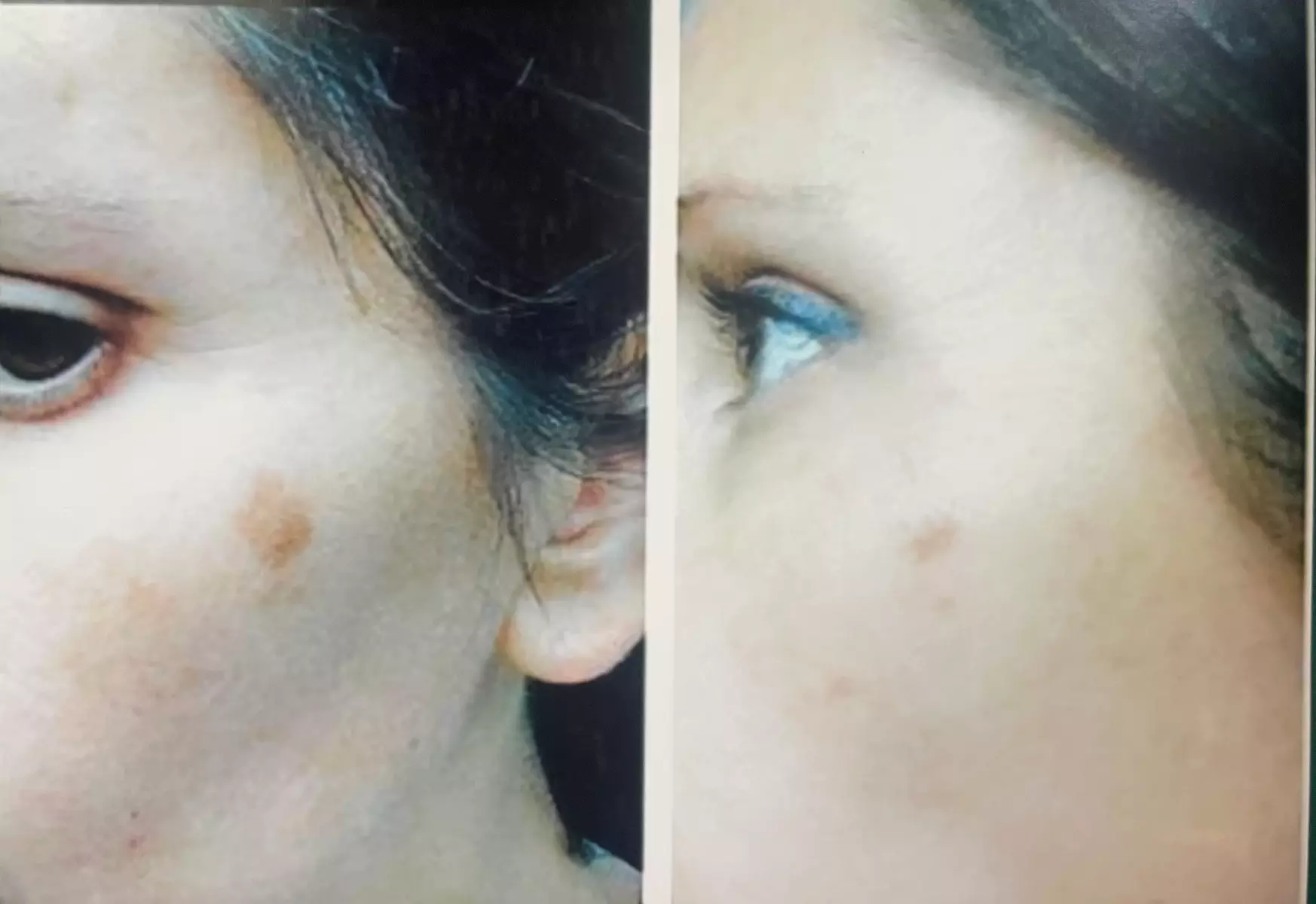 1, 2, or 3 Sessions RF Skin Tightening, Microdermabrasion &  Peel