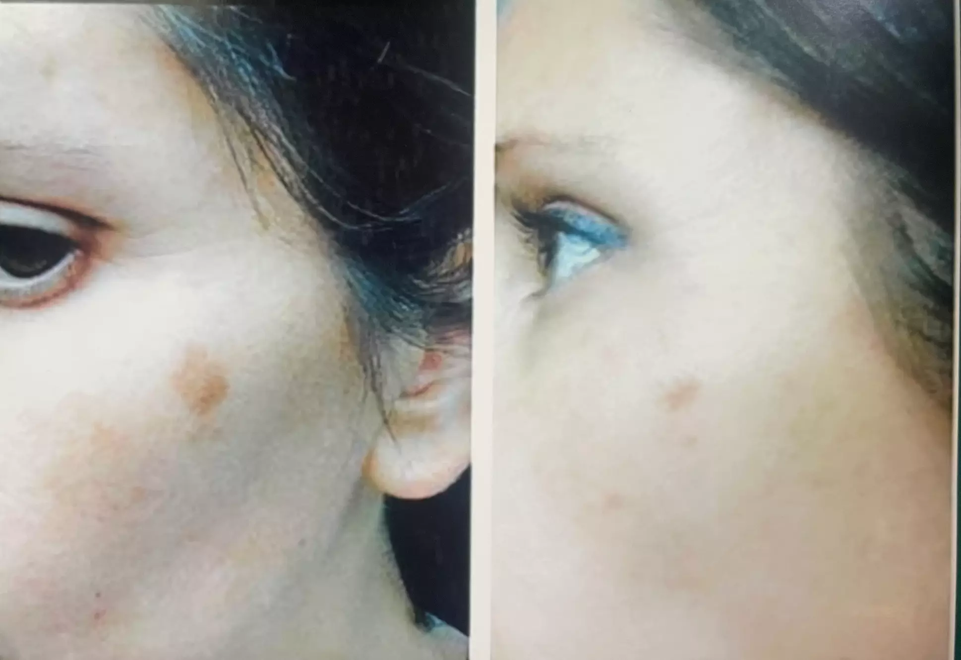 1, 2, or 3 Sessions RF Skin Tightening, Microdermabrasion &  Peel 
