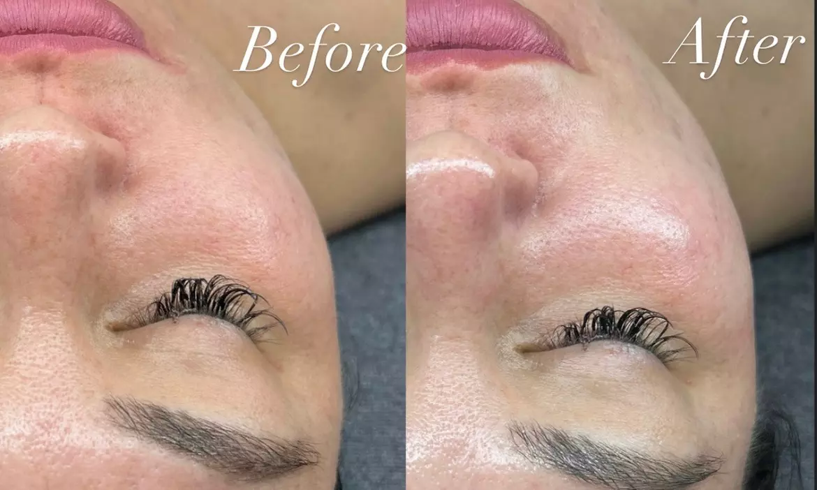 Rejuvenate Your Skin with Microdermabrasion and Facial Options