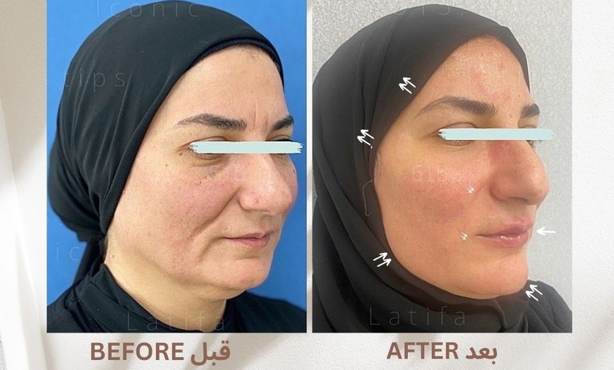 Image 1: Achieve a Natural Look with Dermal Filler 0.5ml, 1ml, or 2ml