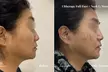 Up to 64% Off on Ultherapy / Ultrasonic Facial at One Beauty Aesthetics - Second Medium
