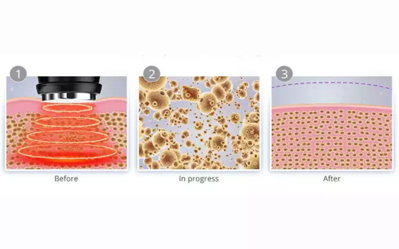 Ultrasonic body sculpting sessions for a toned appearance