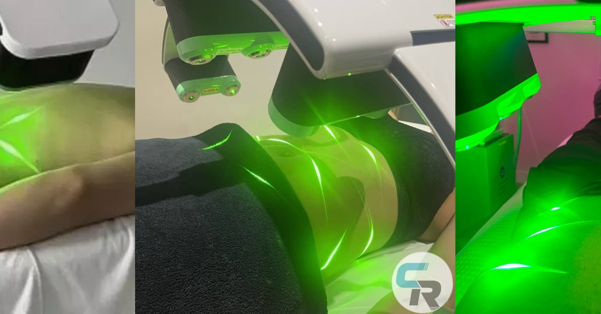 FDA Cleared 10D Green Light Laser Treatment in San Diego, CA