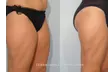 Green Laser Lipo Fat Reduction - Up To 4 inches Loss (Up To 48% Off) - Second Medium