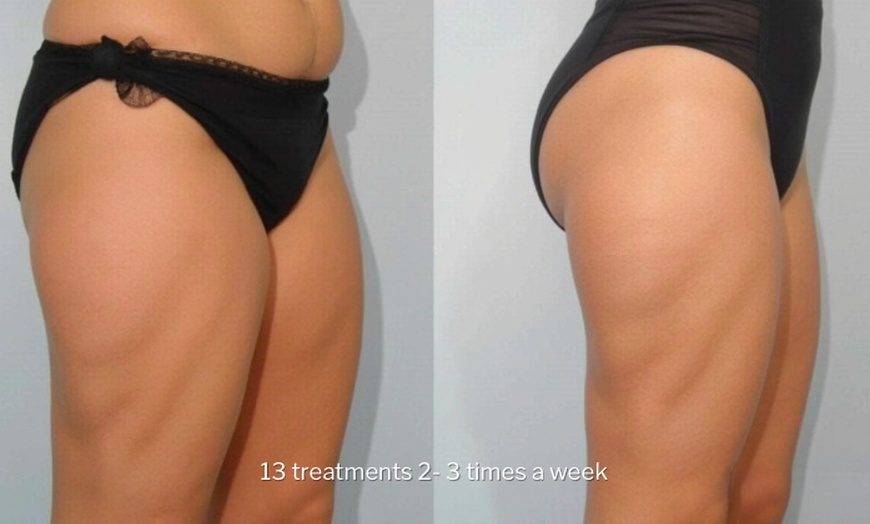 Image 6: Green Laser Lipo Fat Reduction - Up To 4 inches Loss