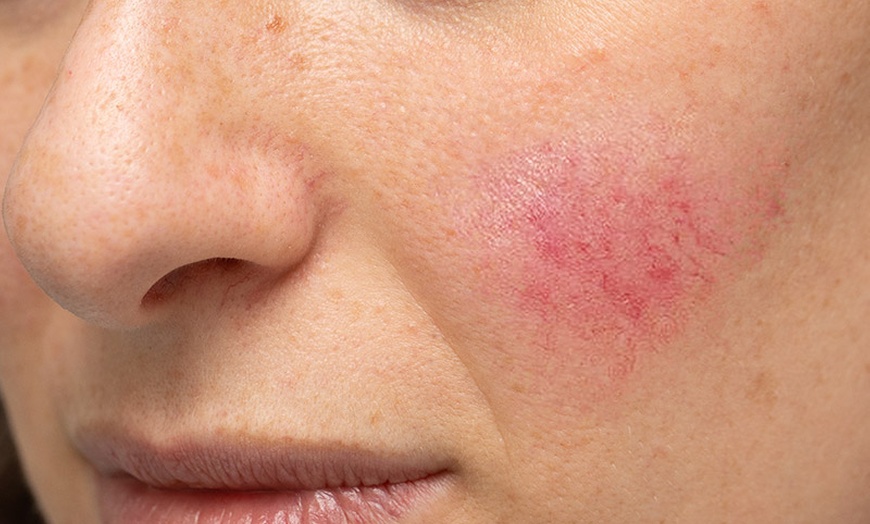 Image 3: Gesichtsbehandlung oder Spezialbehandlung für Problemhaut für 1 Person