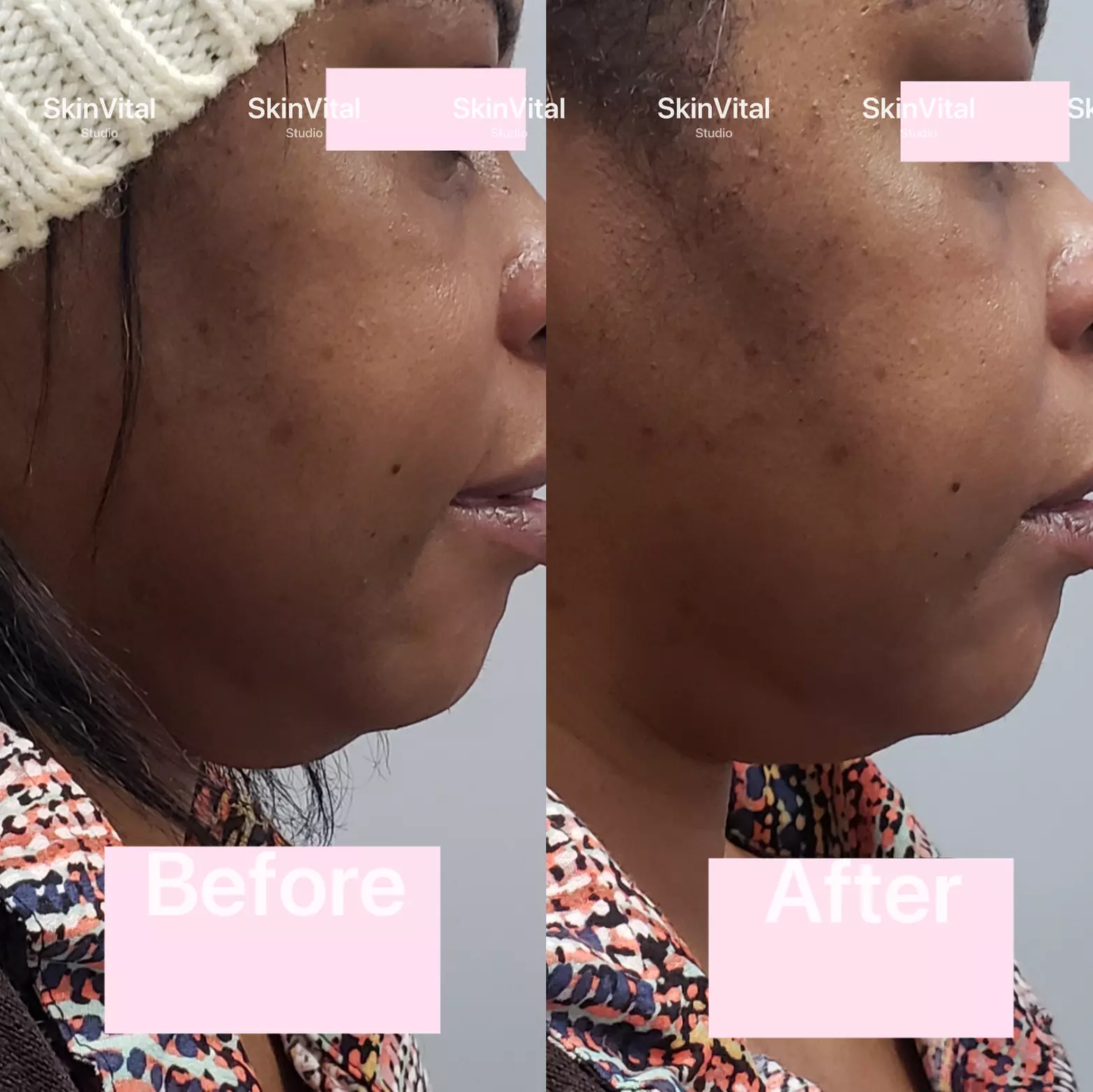 Targeted HIFU Lifting for Chin, Face, or Abdomen